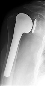 Total shoulder arthroplasty